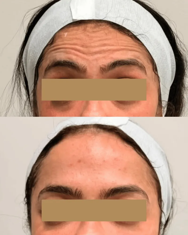 Botox: resultado de paciente da Elyssium Clinic